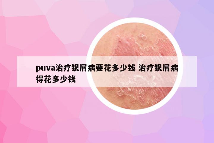 puva治疗银屑病要花多少钱 治疗银屑病得花多少钱