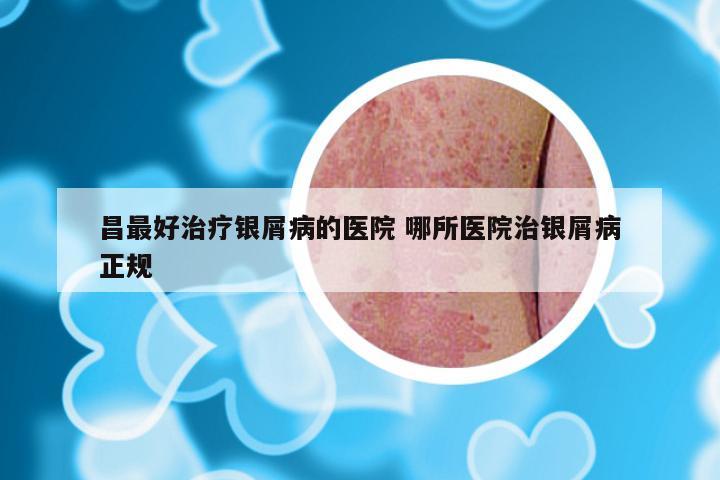 昌最好治疗银屑病的医院 哪所医院治银屑病正规