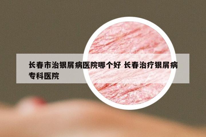 长春市治银屑病医院哪个好 长春治疗银屑病专科医院