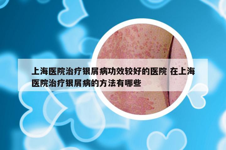 上海医院治疗银屑病功效较好的医院 在上海医院治疗银屑病的方法有哪些
