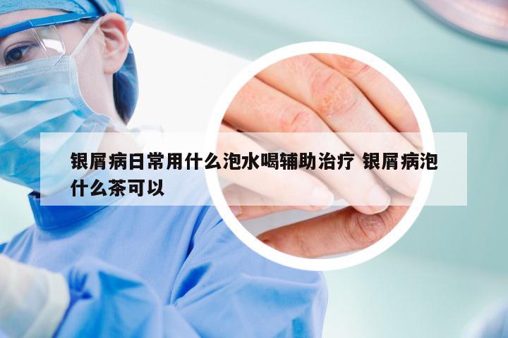 银屑病日常用什么泡水喝辅助治疗 银屑病泡什么茶可以
