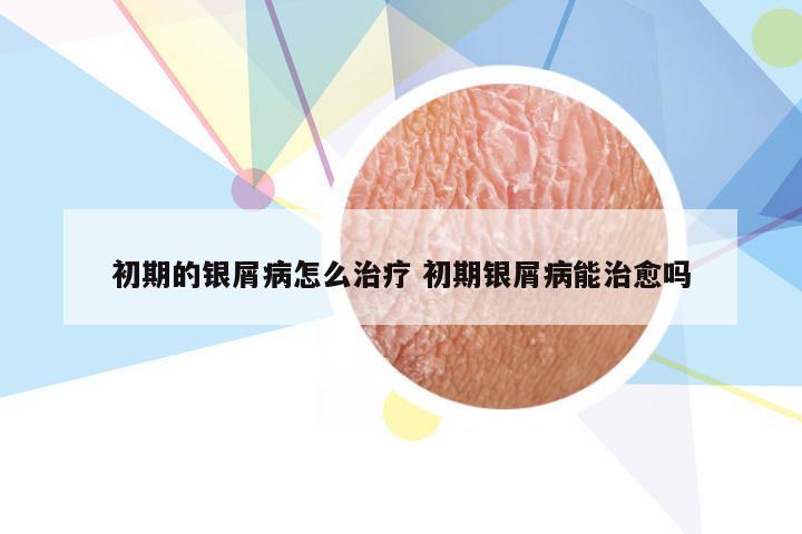 初期的银屑病怎么治疗 初期银屑病能治愈吗