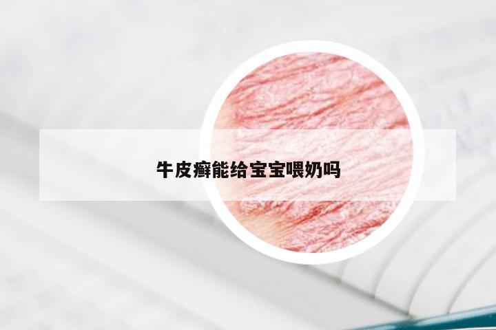 牛皮癣能给宝宝喂奶吗