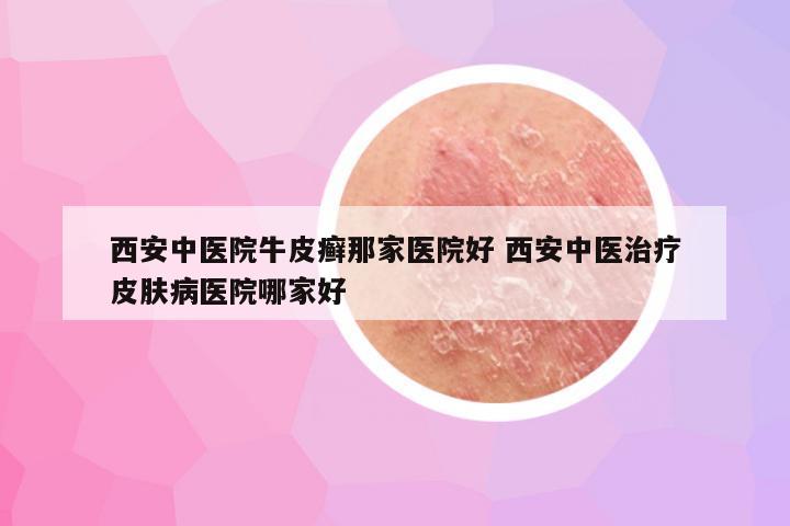西安中医院牛皮癣那家医院好 西安中医治疗皮肤病医院哪家好