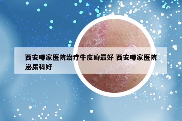 西安哪家医院治疗牛皮癣最好 西安哪家医院泌尿科好