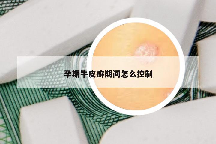 孕期牛皮癣期间怎么控制