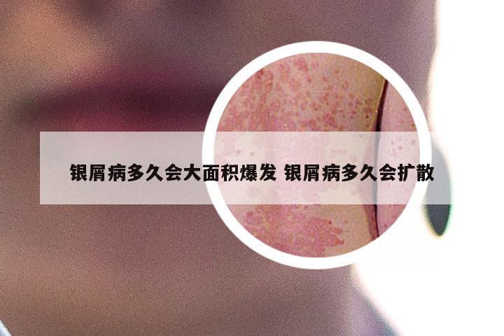 银屑病多久会大面积爆发 银屑病多久会扩散