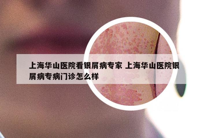 上海华山医院看银屑病专家 上海华山医院银屑病专病门诊怎么样