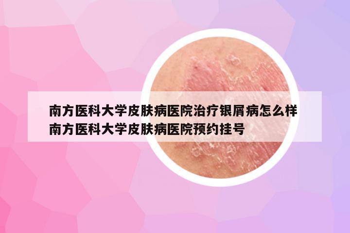 南方医科大学皮肤病医院治疗银屑病怎么样 南方医科大学皮肤病医院预约挂号