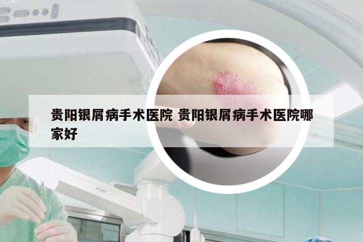 贵阳银屑病手术医院 贵阳银屑病手术医院哪家好