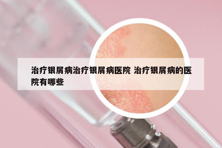 治疗银屑病治疗银屑病医院 治疗银屑病的医院有哪些