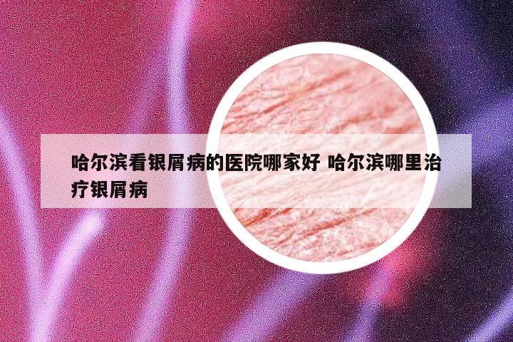 哈尔滨看银屑病的医院哪家好 哈尔滨哪里治疗银屑病