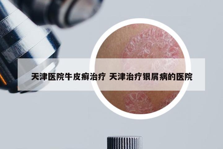 天津医院牛皮癣治疗 天津治疗银屑病的医院