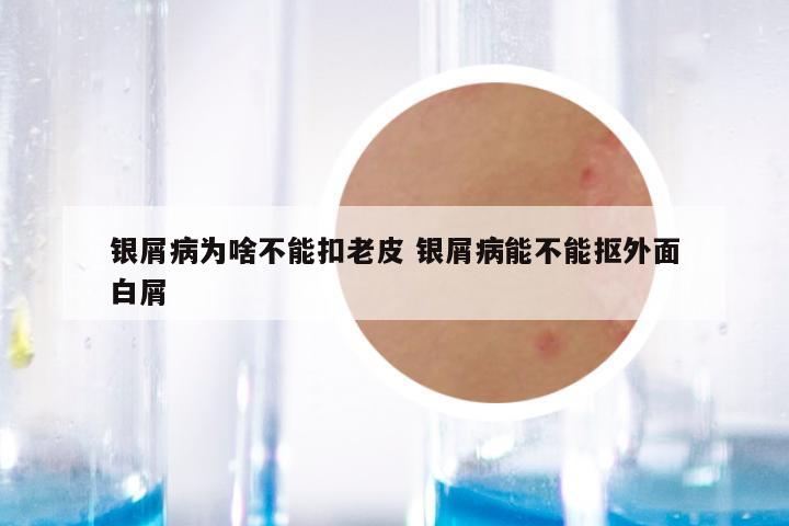 银屑病为啥不能扣老皮 银屑病能不能抠外面白屑