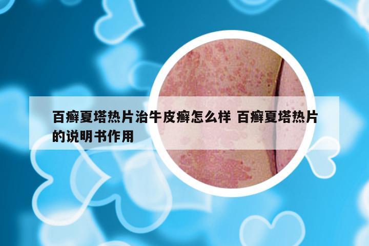 百癣夏塔热片治牛皮癣怎么样 百癣夏塔热片的说明书作用