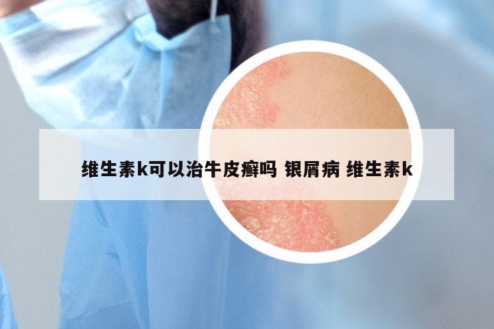 维生素k可以治牛皮癣吗 银屑病 维生素k