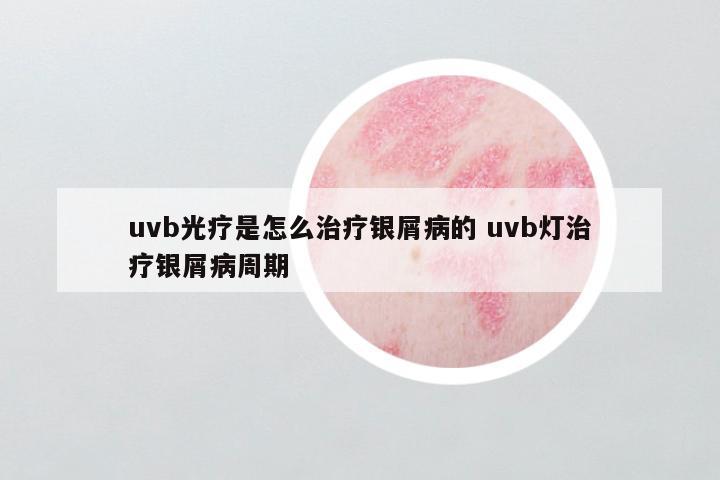 uvb光疗是怎么治疗银屑病的 uvb灯治疗银屑病周期
