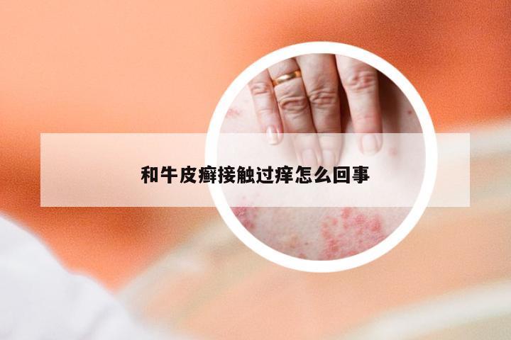 和牛皮癣接触过痒怎么回事