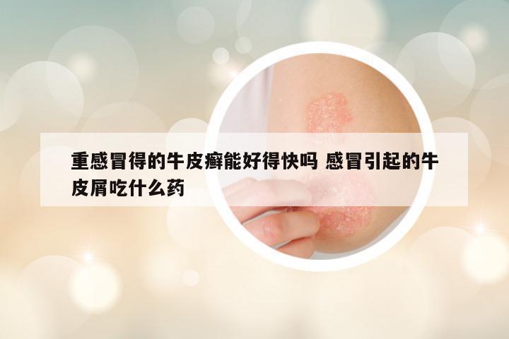 重感冒得的牛皮癣能好得快吗 感冒引起的牛皮屑吃什么药