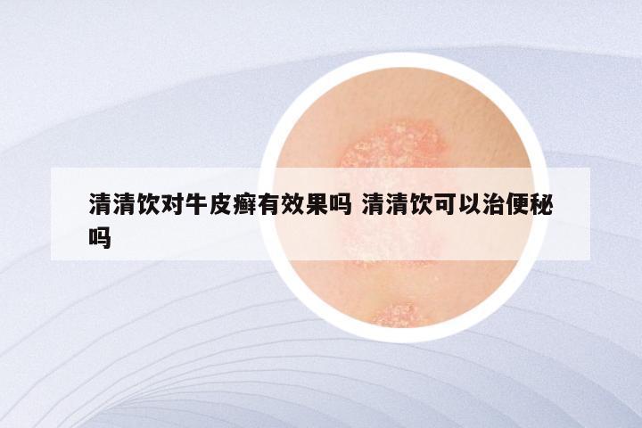 清清饮对牛皮癣有效果吗 清清饮可以治便秘吗