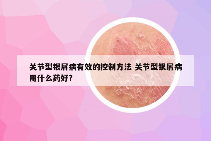 关节型银屑病有效的控制方法 关节型银屑病用什么药好?