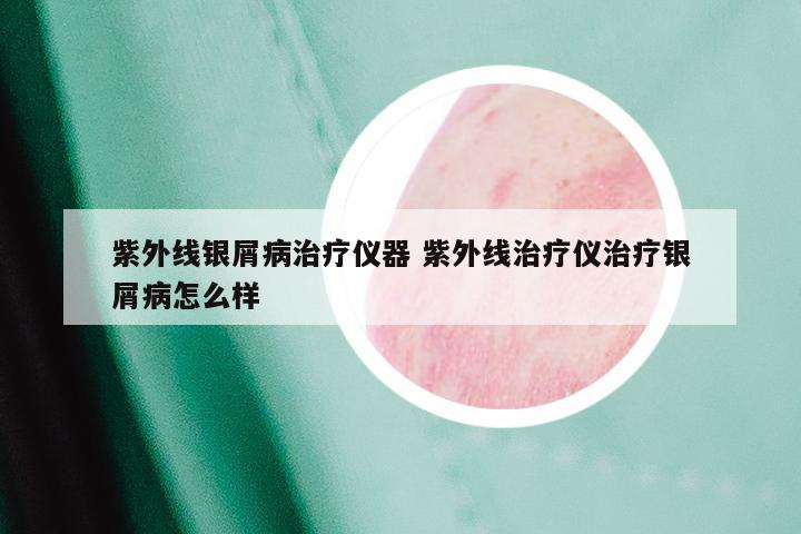 紫外线银屑病治疗仪器 紫外线治疗仪治疗银屑病怎么样