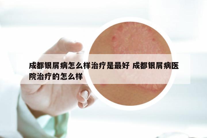 成都银屑病怎么样治疗是最好 成都银屑病医院治疗的怎么样