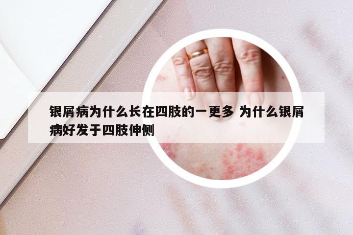 银屑病为什么长在四肢的一更多 为什么银屑病好发于四肢伸侧