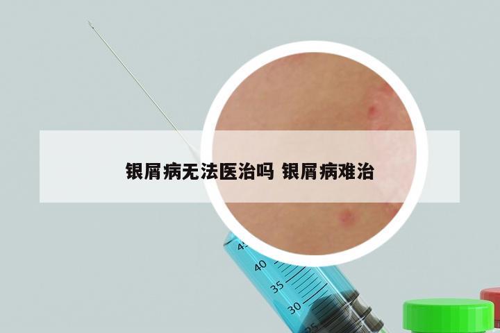 银屑病无法医治吗 银屑病难治