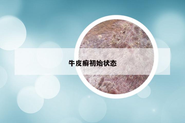 牛皮癣初始状态