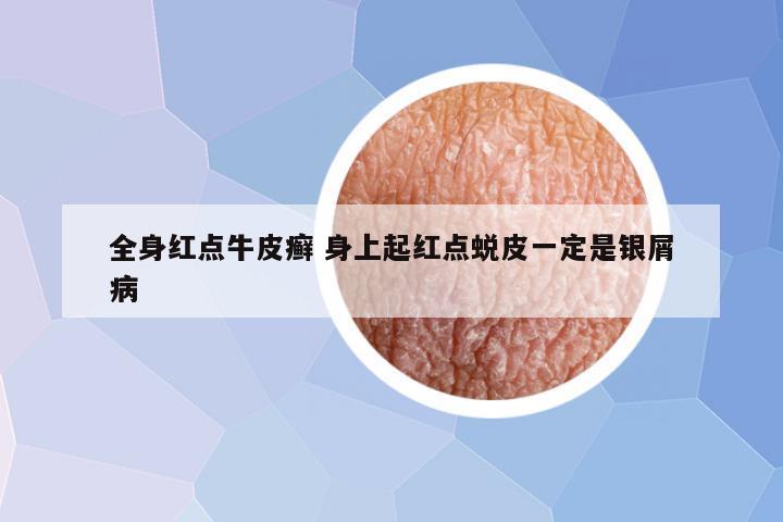 全身红点牛皮癣 身上起红点蜕皮一定是银屑病
