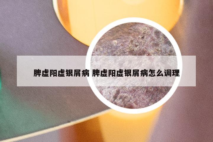 脾虚阳虚银屑病 脾虚阳虚银屑病怎么调理