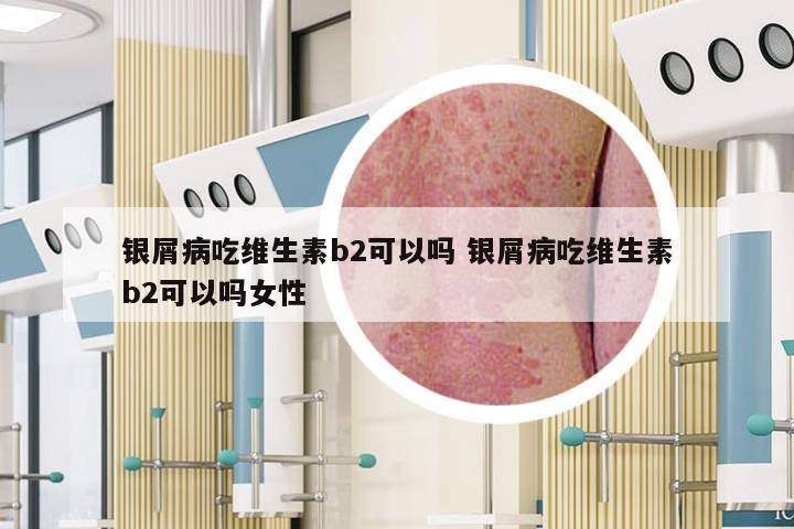 银屑病吃维生素b2可以吗 银屑病吃维生素b2可以吗女性