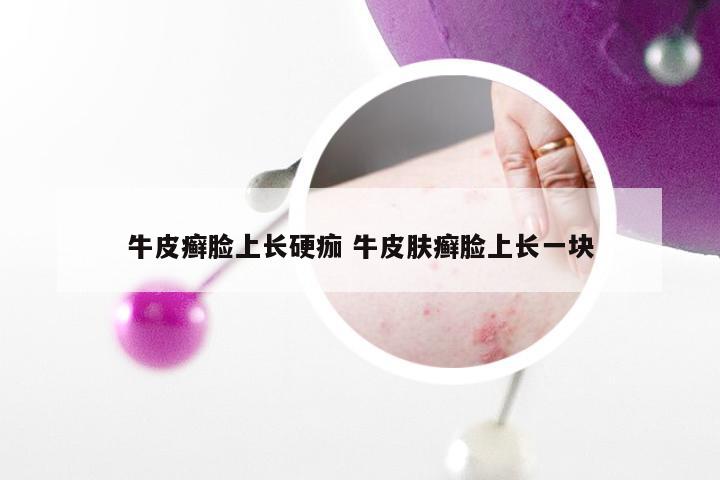 牛皮癣脸上长硬痂 牛皮肤癣脸上长一块