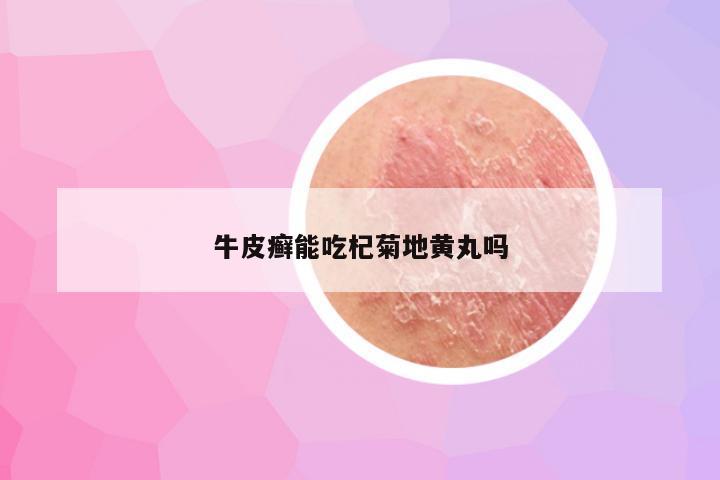 牛皮癣能吃杞菊地黄丸吗