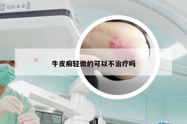 牛皮癣轻微的可以不治疗吗