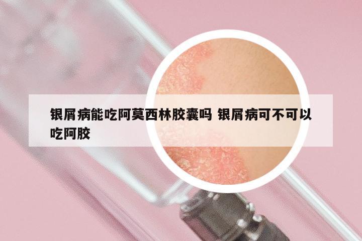 银屑病能吃阿莫西林胶囊吗 银屑病可不可以吃阿胶