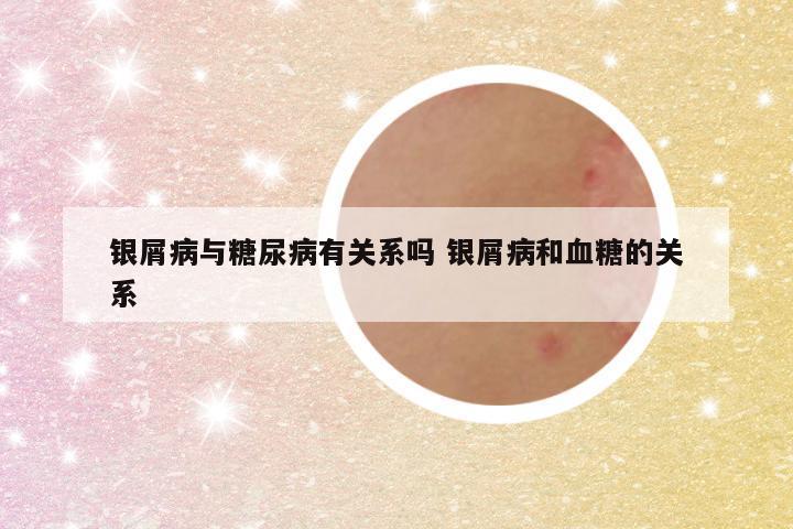 银屑病与糖尿病有关系吗 银屑病和血糖的关系