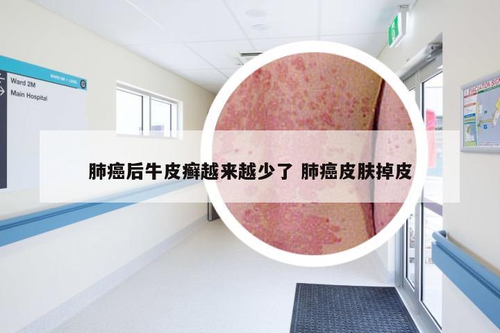 肺癌后牛皮癣越来越少了 肺癌皮肤掉皮