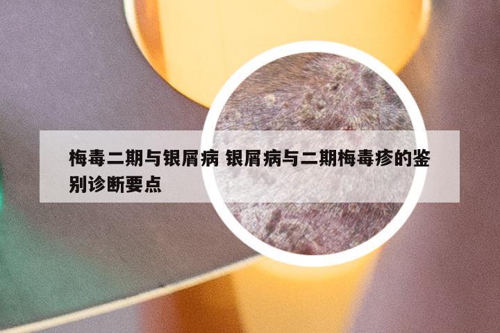 梅毒二期与银屑病 银屑病与二期梅毒疹的鉴别诊断要点