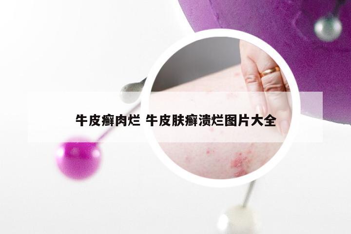 牛皮癣肉烂 牛皮肤癣溃烂图片大全