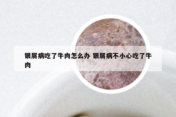 银屑病吃了牛肉怎么办 银屑病不小心吃了牛肉