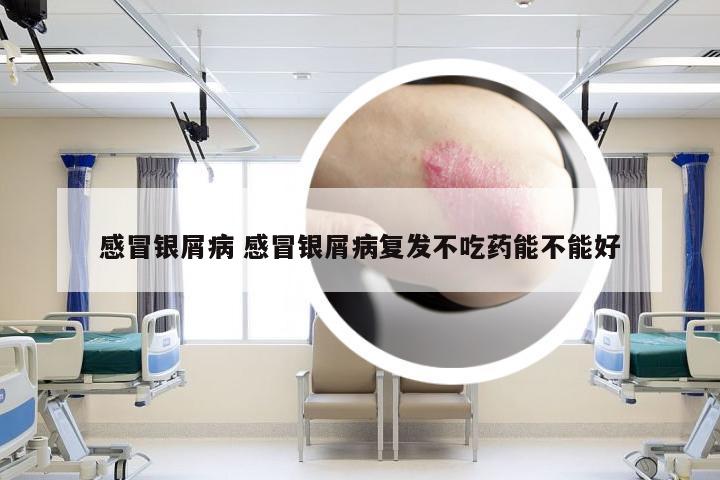 感冒银屑病 感冒银屑病复发不吃药能不能好