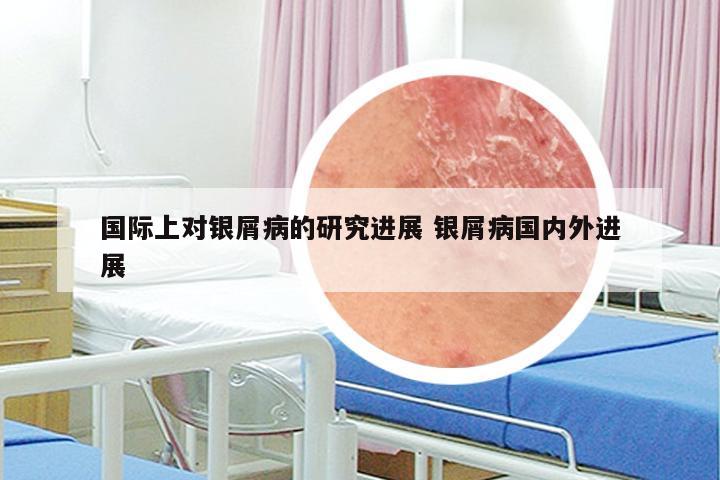 国际上对银屑病的研究进展 银屑病国内外进展