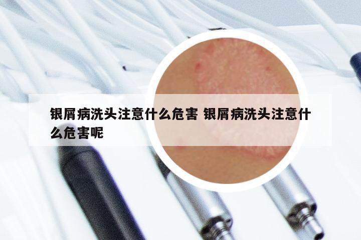 银屑病洗头注意什么危害 银屑病洗头注意什么危害呢
