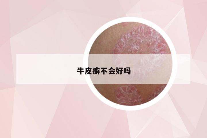 牛皮癣不会好吗