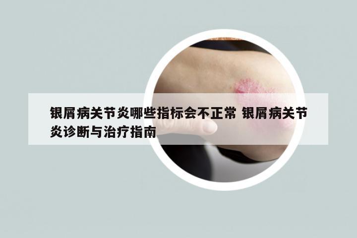 银屑病关节炎哪些指标会不正常 银屑病关节炎诊断与治疗指南