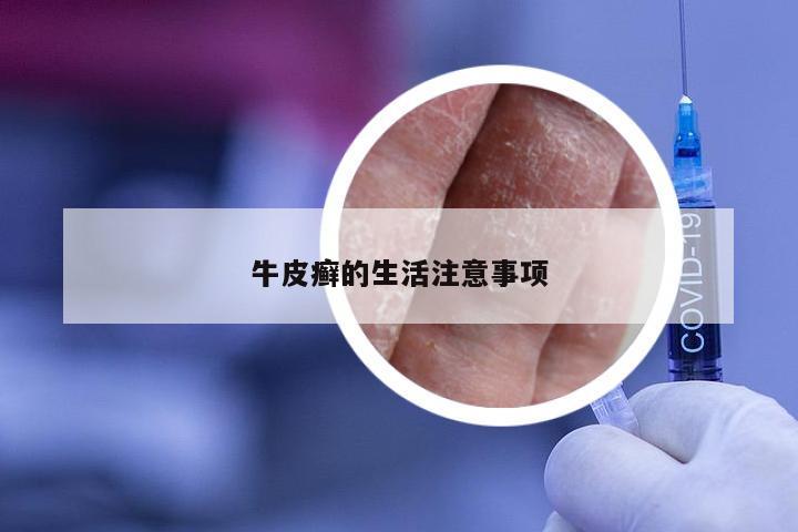 牛皮癣的生活注意事项