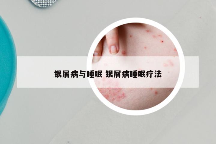 银屑病与睡眠 银屑病睡眠疗法