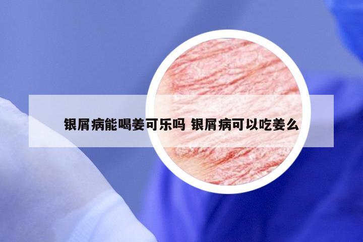 银屑病能喝姜可乐吗 银屑病可以吃姜么